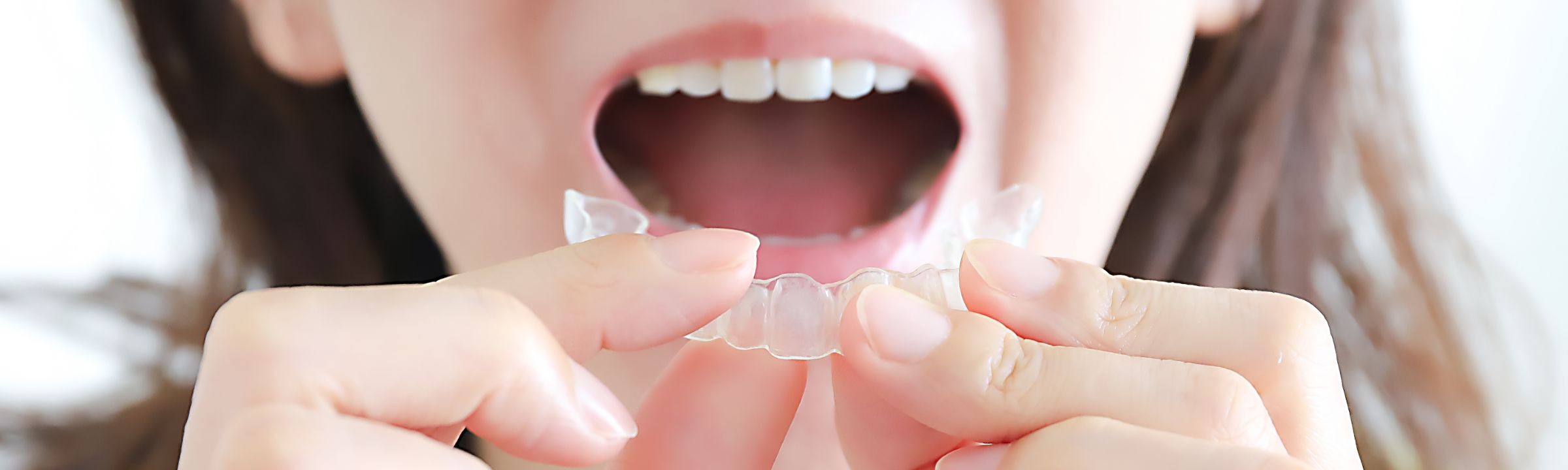 マウスピース矯正