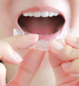 マウスピース矯正